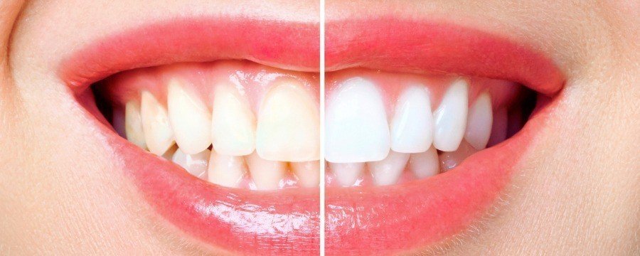Packs blanchiment dents
